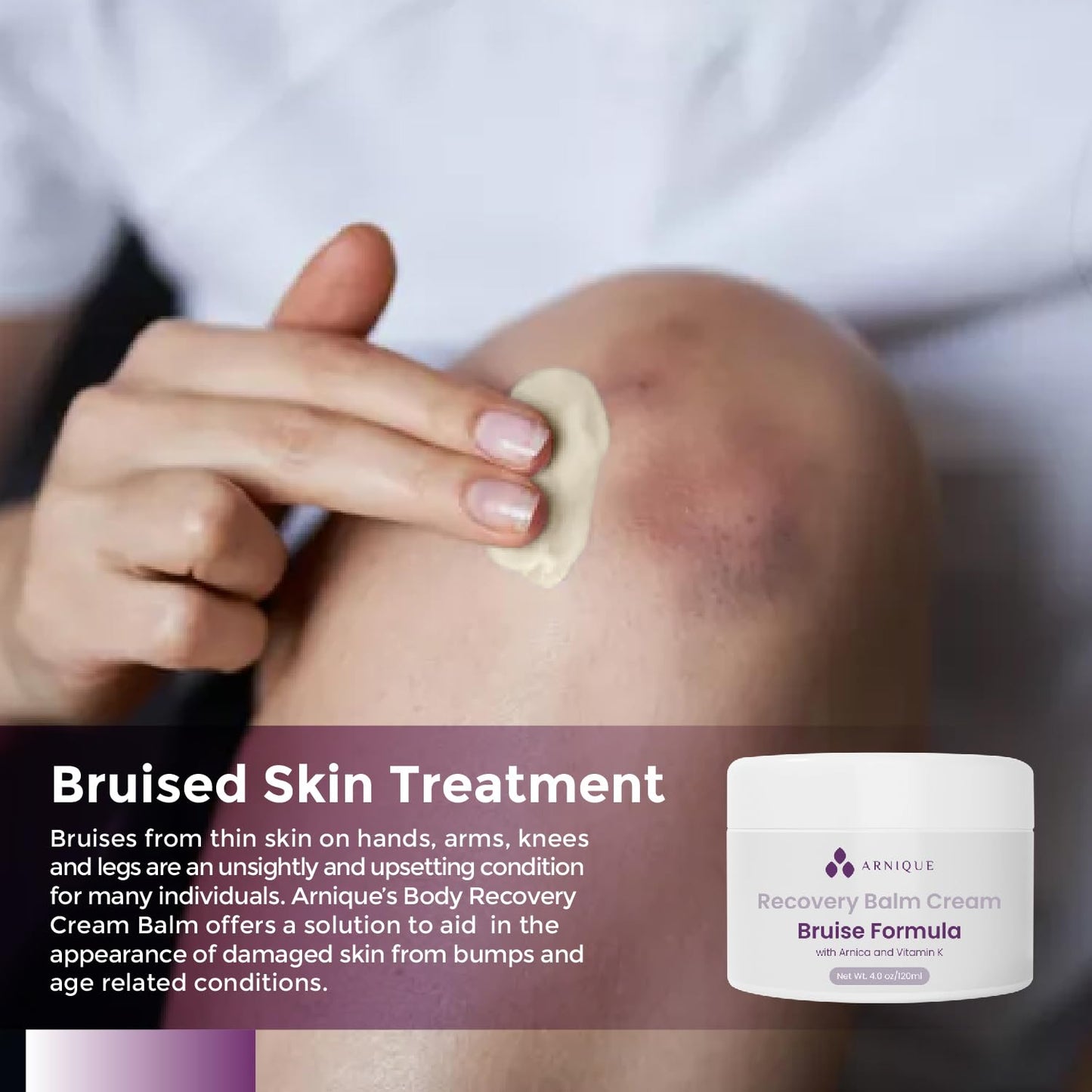 Arnica Bruise Cream with Vitamin K, Extra Strength Fast Healing Thin Skin Formula, Senile Purpura or Redness, Visibly Aide Remove Bruises Elderly and Fragile Skin, Surgery Aftercare