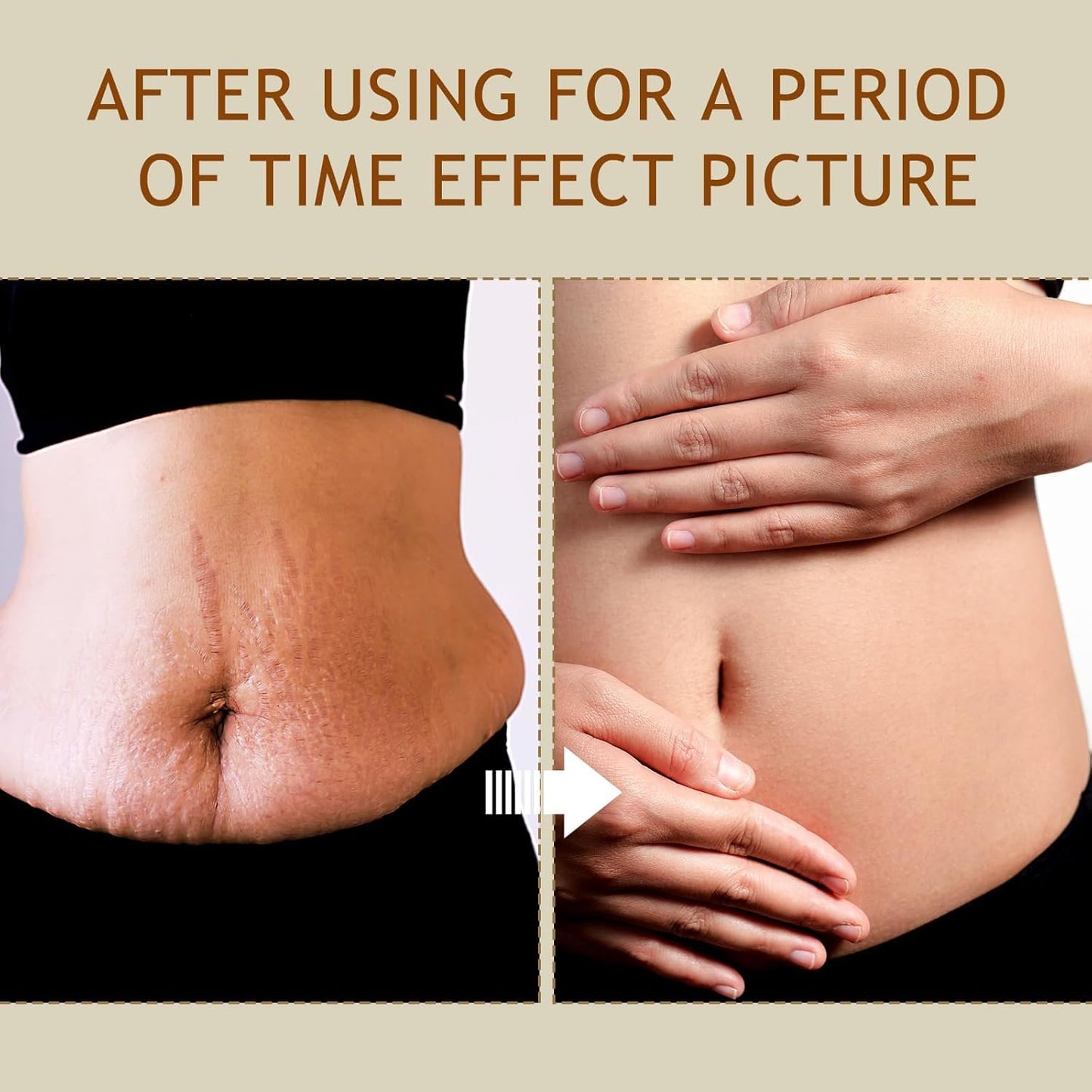 B Flat Belly Firming Cream - Stretch Mark Treatment - Clean and Gentle Belly Cream - Skin Tightening Cream for Cellulite for Stomach Mark & Thighs & Butt, Moisturizing Lifting Body Lotion