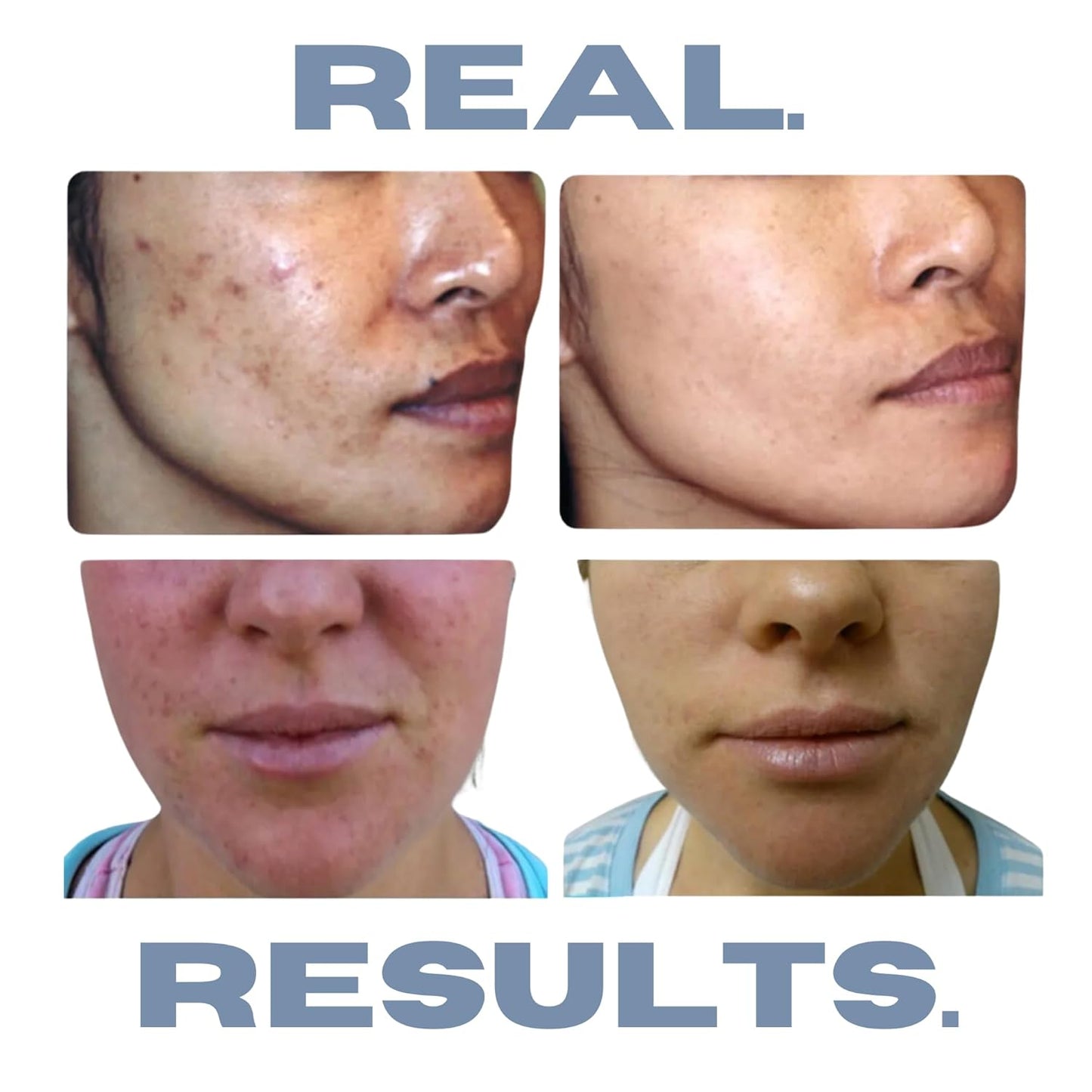 Acne Treatment Kit, Acne Kit, Skin Care Acne, Acne Skin Care Set, Natural Anti-DHT Deluxe Set Sensitive Skin 3-Piece Set, 2-Month Supply