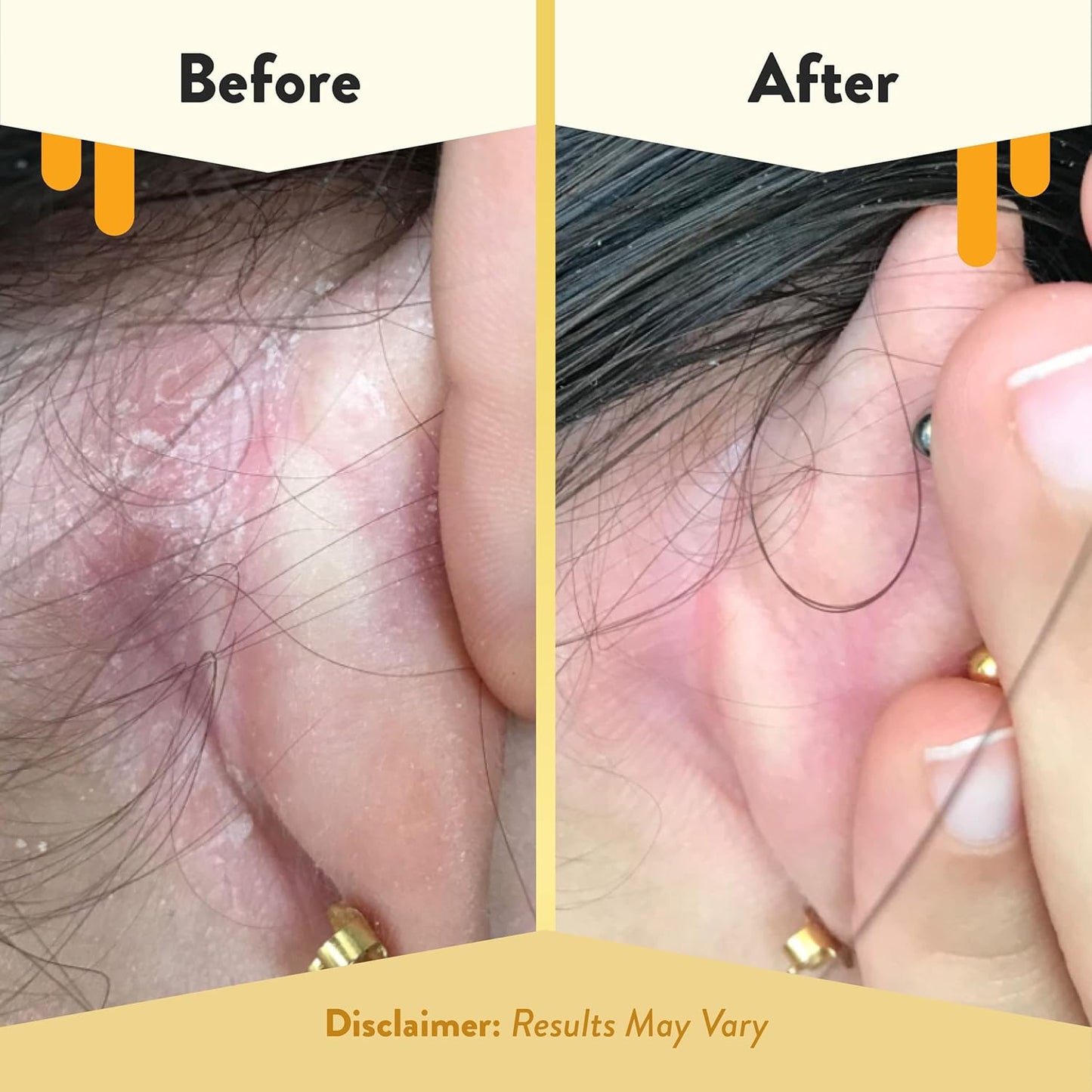 ECZEMA HONEY Gentle Face & Body Lotion Stick - Moisturizing Colloidal Oatmeal Hand Cream for Extremely Dry Skin - Eczema Lotion Helps Psoriasis, Dermatitis & More (2.2 Oz)